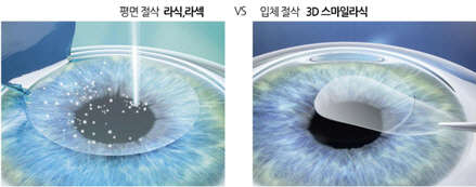 3D½º¸¶ÀÏ ±â¼ú·Â, `¶ó½Ä »Ó¸¸ ¾Æ´Ï¶ó ³ë¾È¼ö¼ú¿¡¼µµ Àû¿ë °¡´É` 3D½º¸¶ÀÏ ±â¼ú·Â, `¶ó½Ä »Ó¸¸ ¾Æ´Ï¶ó ³ë¾È¼ö¼ú¿¡¼µµ Àû¿ë °¡´É`